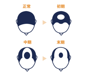 複合型脱毛症状の原因【症状から探す】