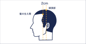M字型に進行する脱毛症状の原因【症状から探す】