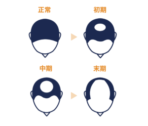 頭頂部から進行する脱毛症状の原因【症状から探す】