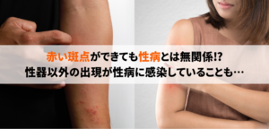 性病で赤い斑点・湿疹(皮疹)・ブツブツの症状が出る性病の種類について解説