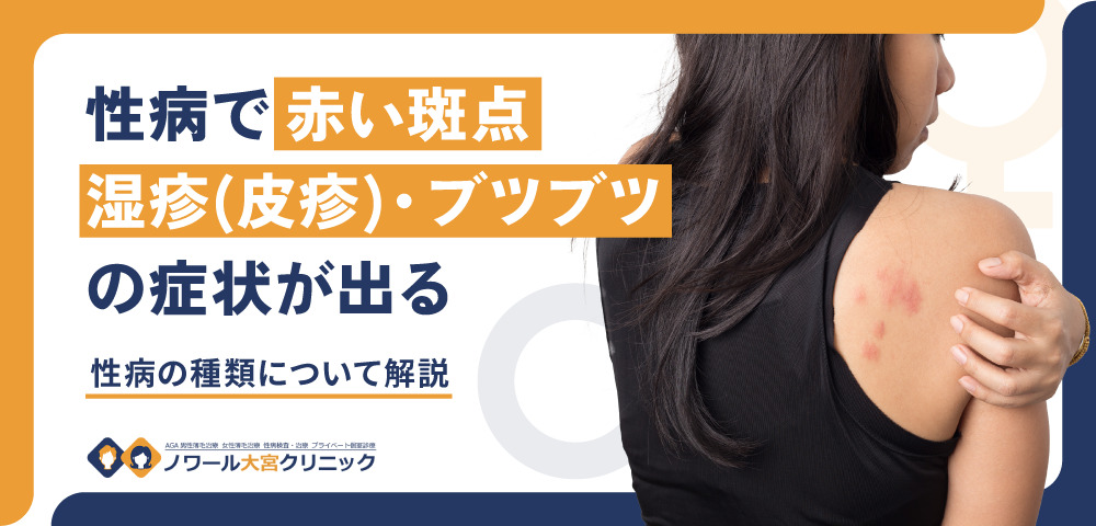 性病で赤い斑点・湿疹(皮疹)・ブツブツの症状が出る性病の種類について解説